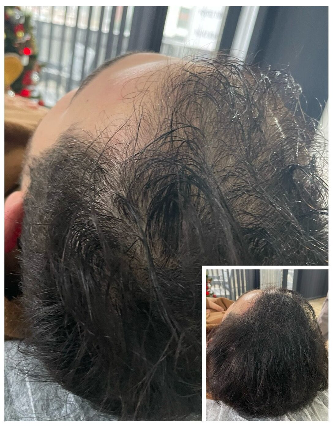 Saç Simülasyonu İşlemi (Saç Gölgelendirme), Ayss Beauty Center