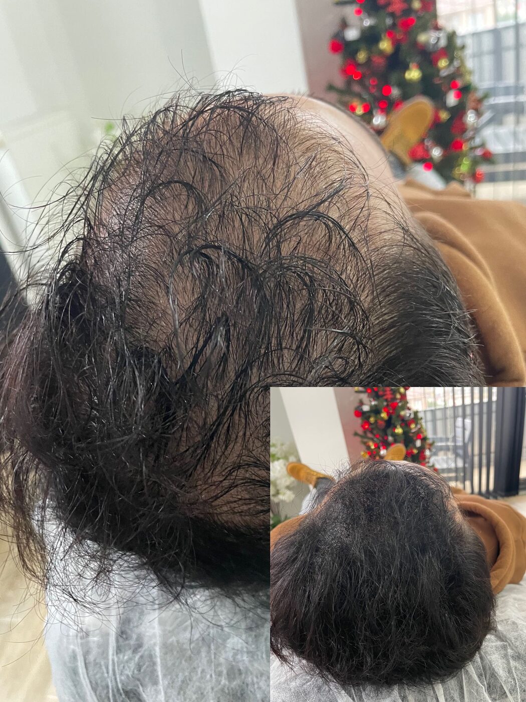 Saç Simülasyonu İşlemi (Saç Gölgelendirme), Ayss Beauty Center