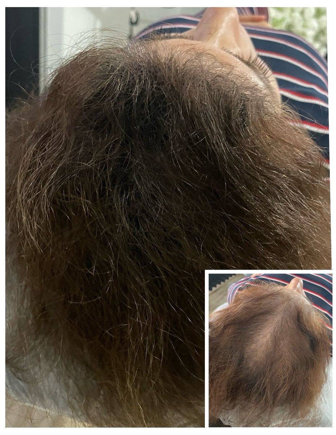 Saç Simülasyonu İşlemi (Saç Gölgelendirme), Ayss Beauty Center