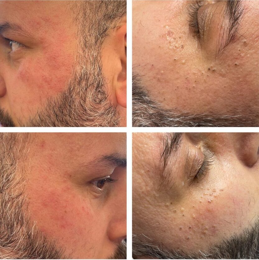 Klasik Cilt Bakımı, Ayss Beauty Center