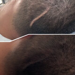 Saç simülasyonu ile saçınızdaki açık yerleri kapatabilirsiniz 🌸🤍
İt’s just your glow ✨
#proteztırnaksakarya #kalıcıojesakarya #kalıcımakyajsakarya #microbladingsakarya #ciltbakımısakarya #lazerepilasyonsakarya #ipekkirpiksakarya #kirpikliftingsakarya #kaşlaminasyonu #saçvitamini #kaşvitaminisakarya #keşfet
#saçsimülasyonu