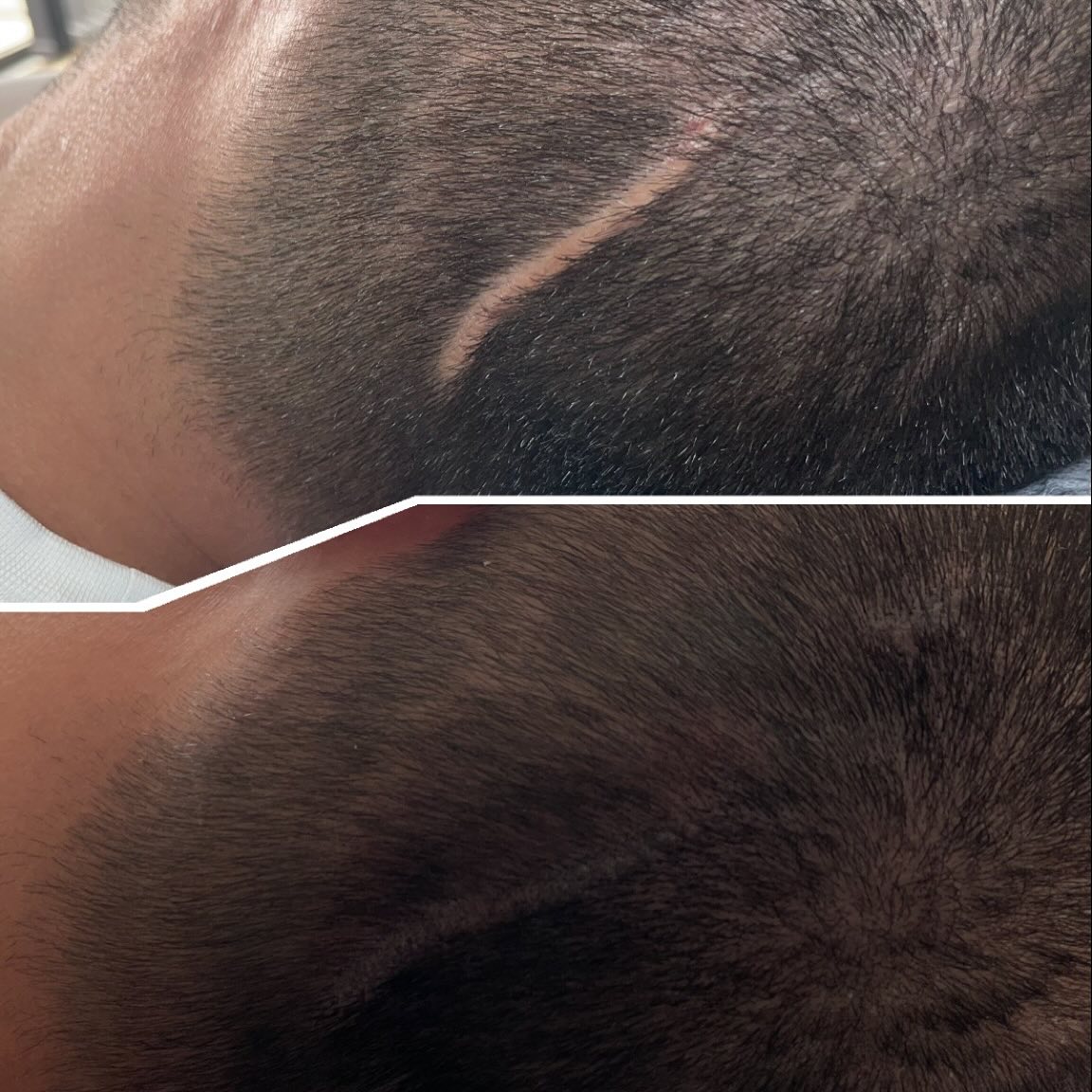 Saç simülasyonu ile saçınızdaki açık yerleri kapatabilirsiniz 🌸🤍
İt’s just your glow ✨
#proteztırnaksakarya #kalıcıojesakarya #kalıcımakyajsakarya #microbladingsakarya #ciltbakımısakarya #lazerepilasyonsakarya #ipekkirpiksakarya #kirpikliftingsakarya #kaşlaminasyonu #saçvitamini #kaşvitaminisakarya #keşfet
#saçsimülasyonu